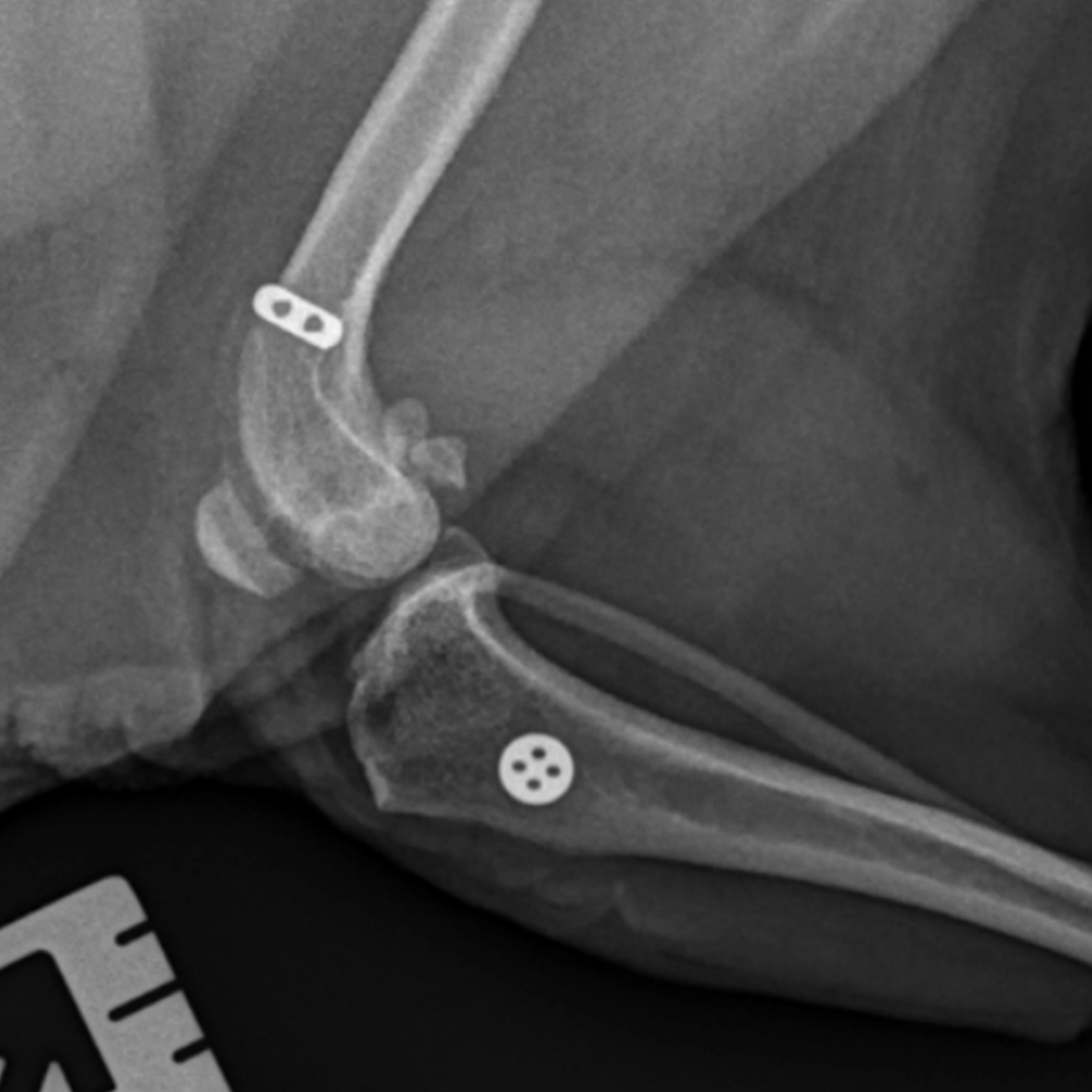 Arthrex Tightrope System