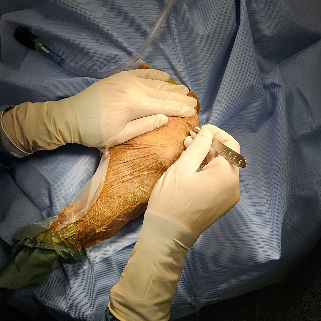 Arthrex Tightrope System