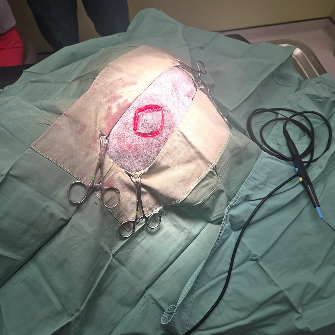 The beginning stages of oncology surgery