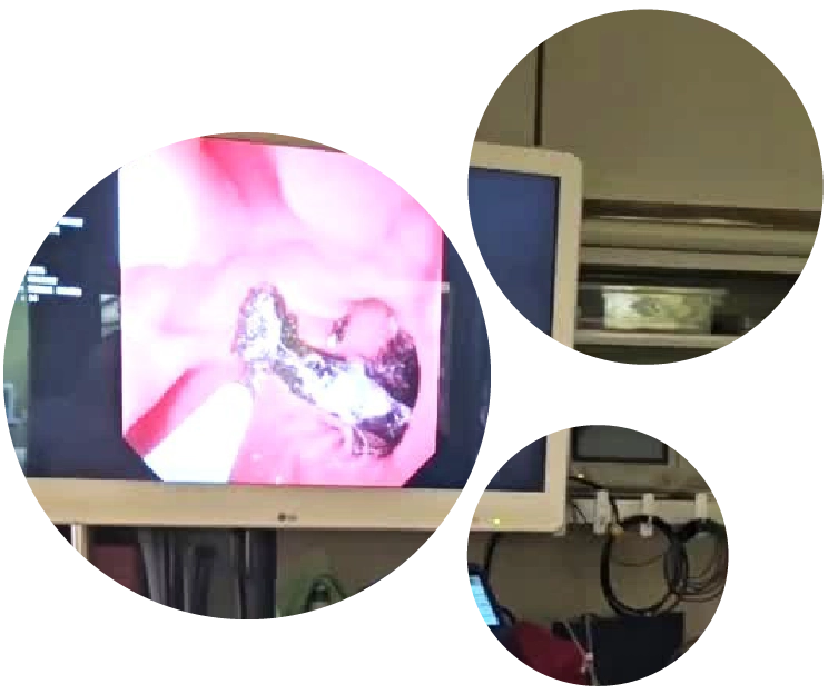 laparscopy treatment